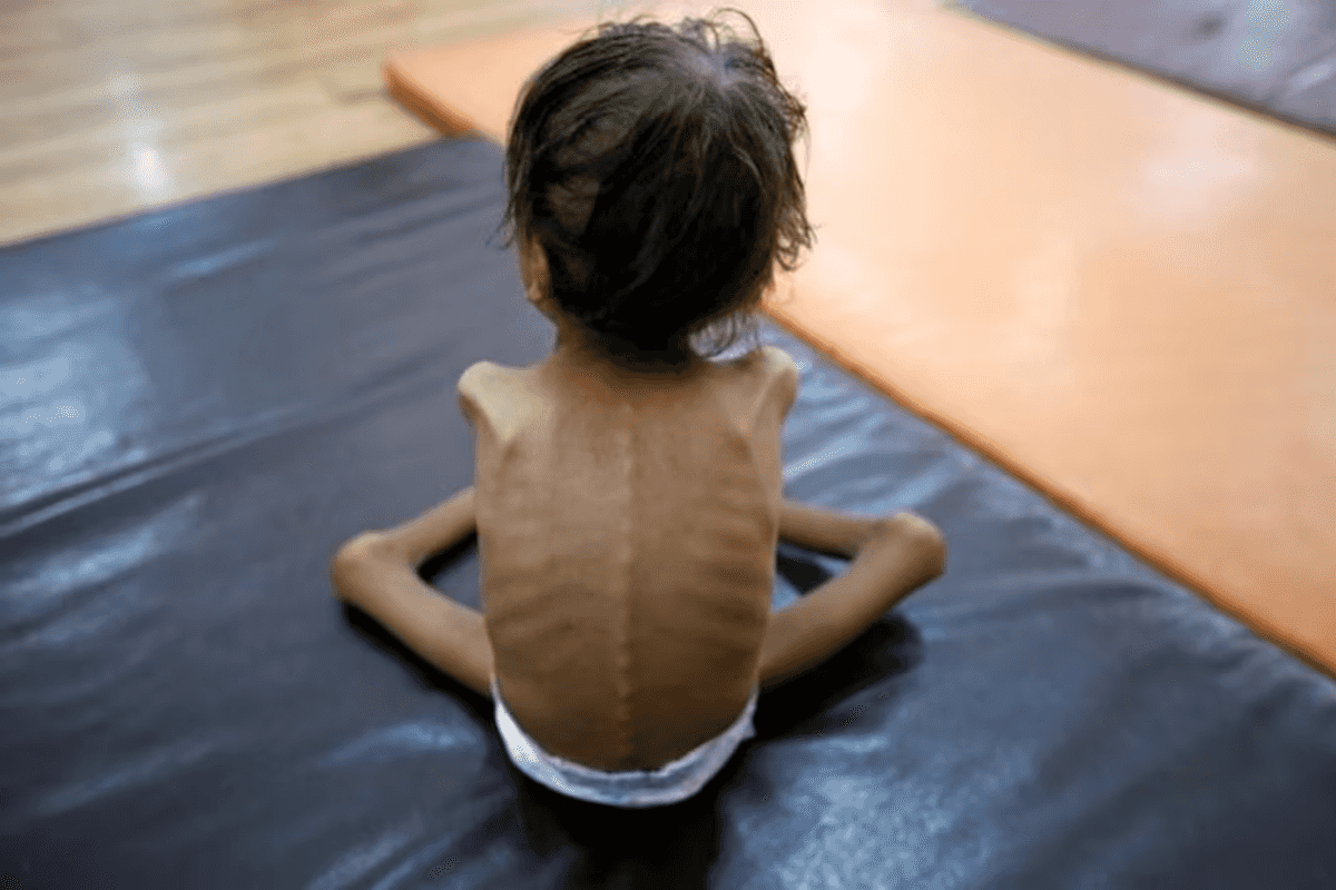 Pakistan faces alarming malnutrition crisis, health minister warns