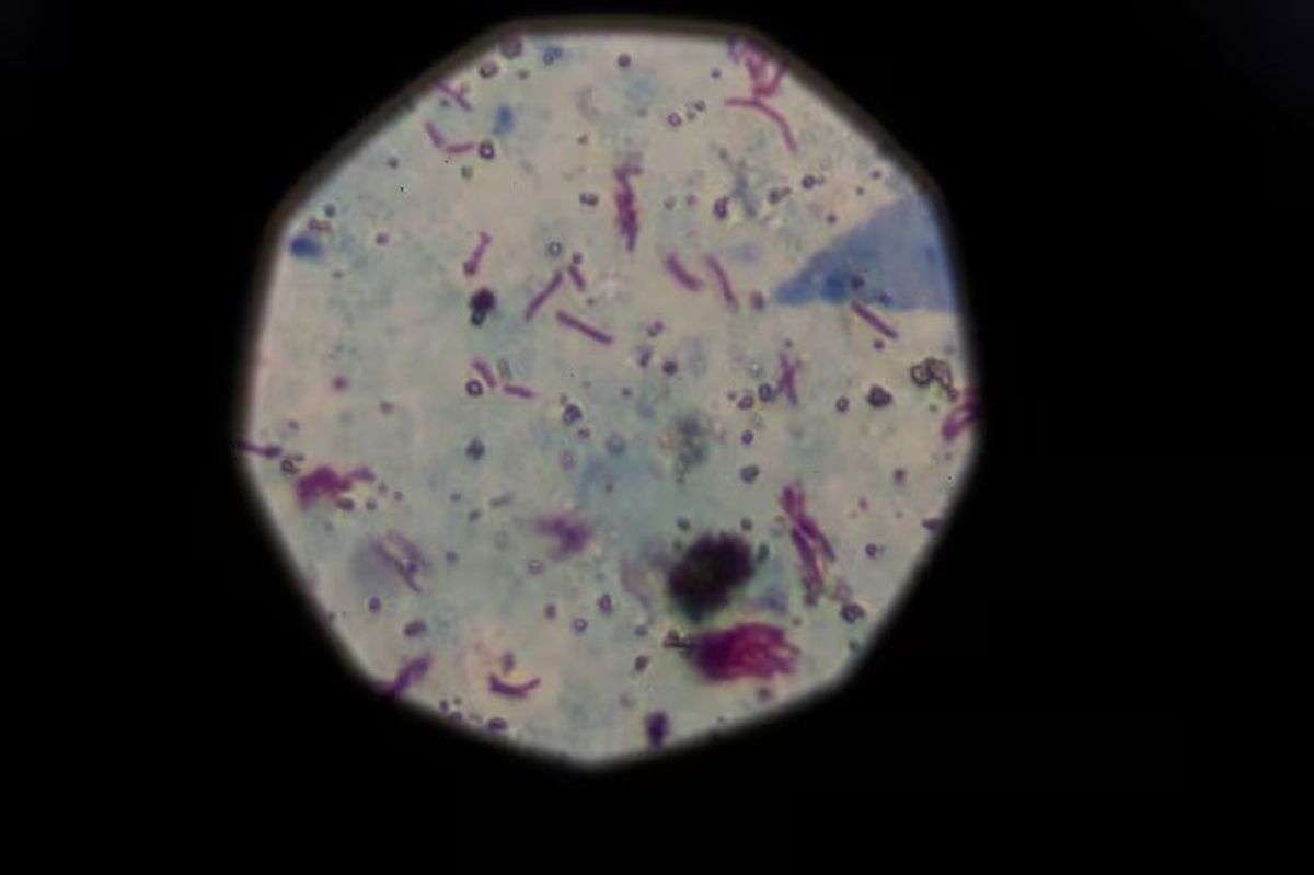 Antibiotic-resistance deaths to surge from 2025-2050, study says