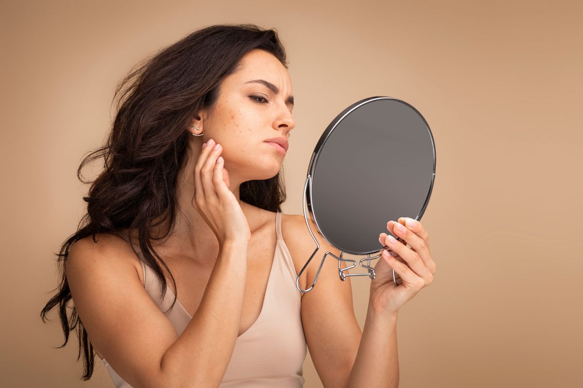 Skin deep: the toll acne takes