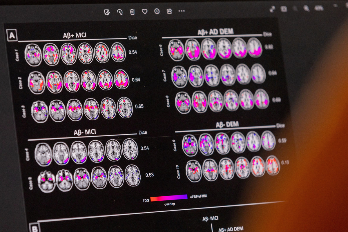 US approves first blood test for Alzheimer's