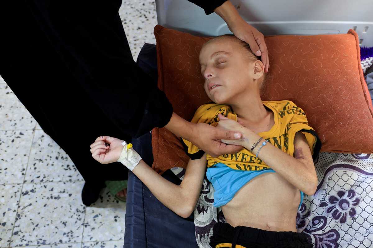 Nearly 12,000 children under five in Gaza have acute malnutrition, says WHO