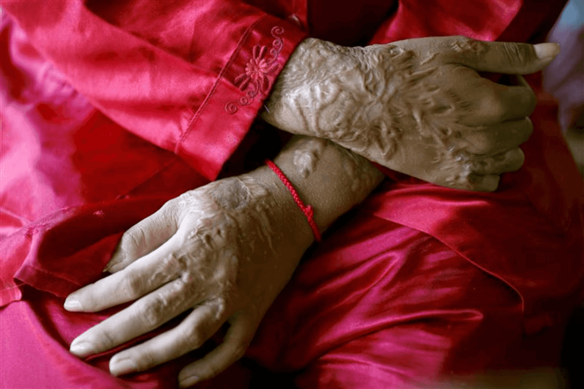 Pakistan's top court orders survivor fund in landmark acid attack ruling