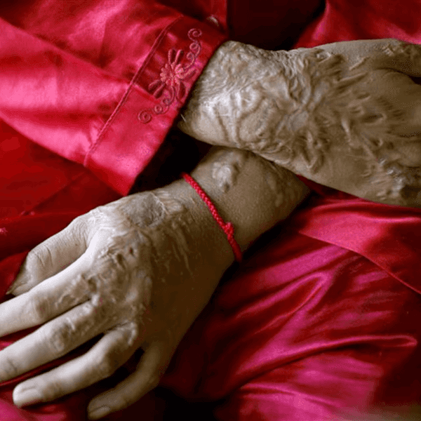 Pakistan's top court orders survivor fund in landmark acid attack ruling
