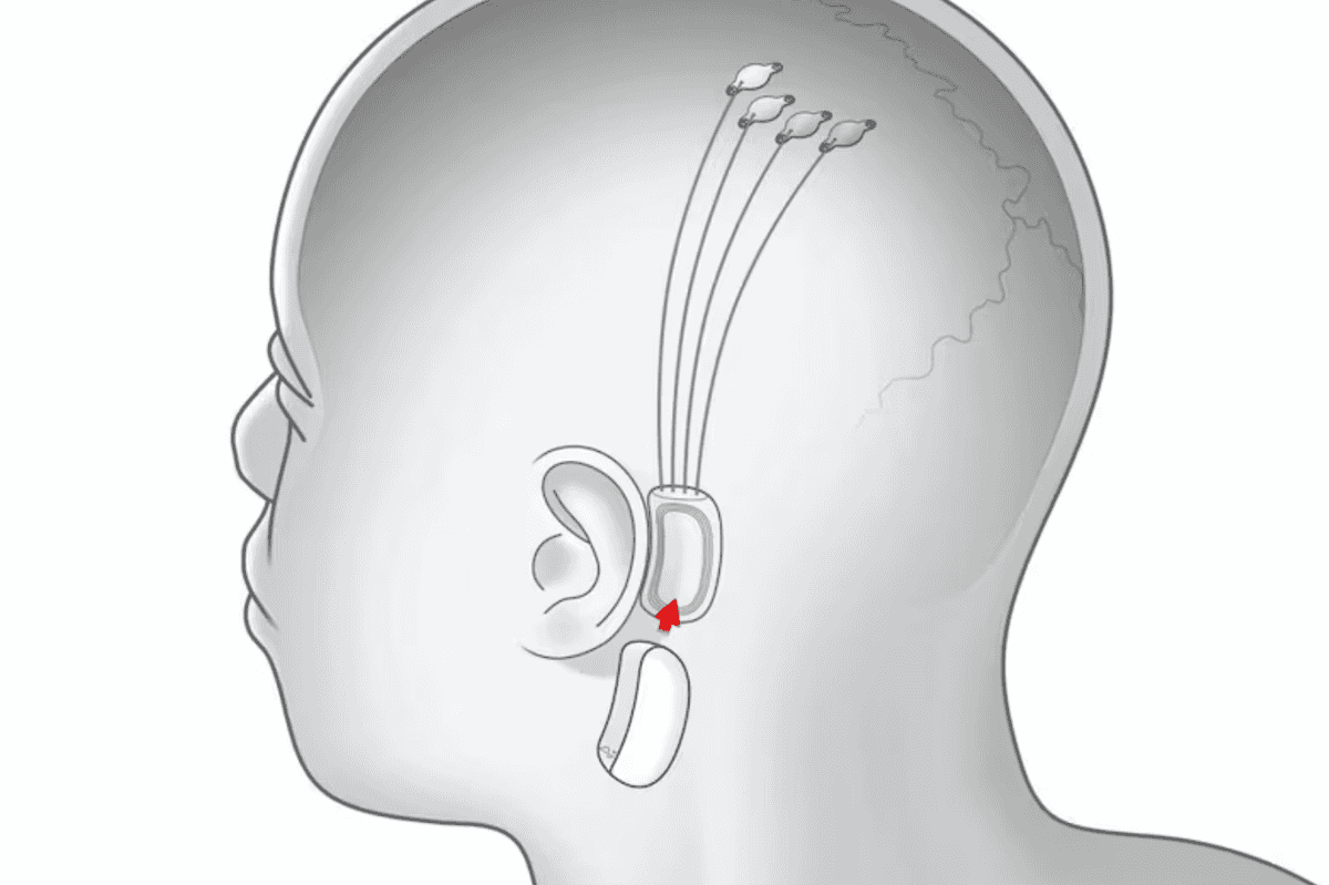 UAE to host first Neuralink brain chip trials outside the US