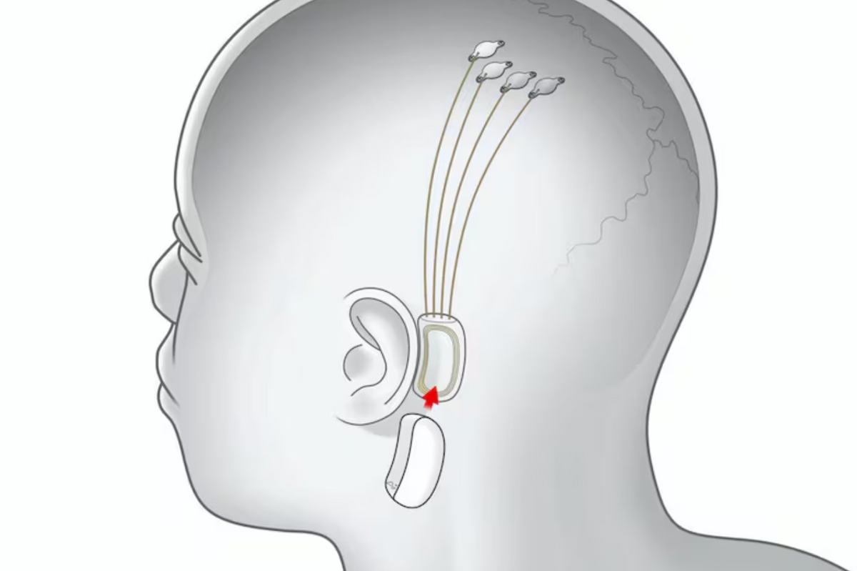 UAE to host first Neuralink brain chip trials outside the U.S.