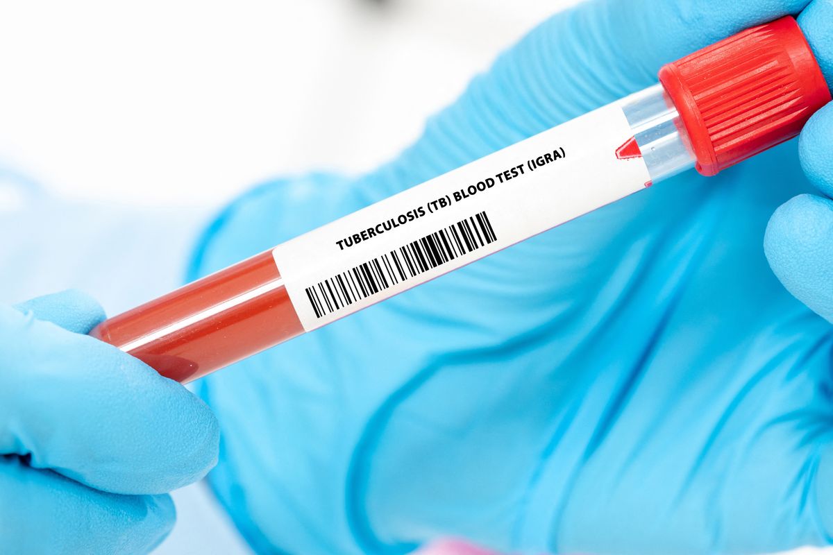 Pakistan's KP accused of inflating TB cases to unlock aid